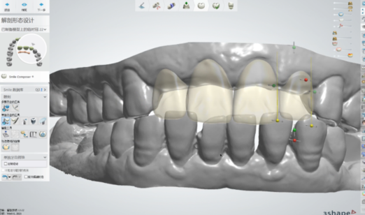 临时诊断蜡型和数字化预备牙模型制作