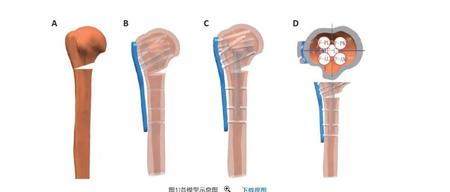 肱骨近端骨折中不同腓骨支撑方式重建内侧柱的有限元分析