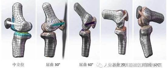 不同股骨止点对内侧髌股韧带重建后髌股关节应力影响的三维有限元分析