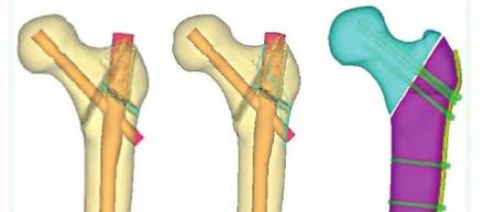 外侧壁破裂股骨粗隆间骨折三种内固定有限元分析