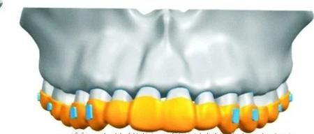 牙周膜参数设定差异对正畸生物力学有限元分析结果的影响