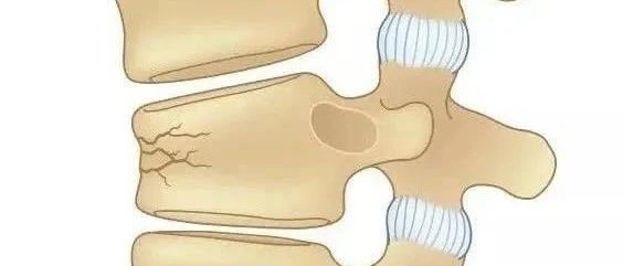 不同治疗方法对骨质疏松性胸腰椎压缩骨折椎体力学稳定性影响的有限元分析