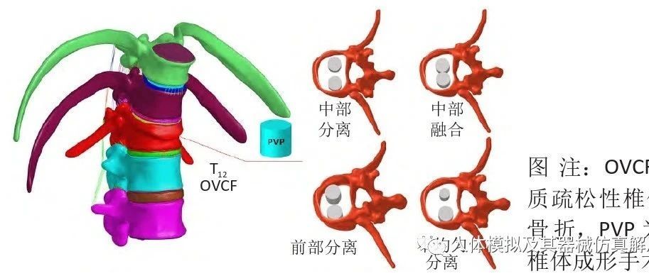 骨水泥弥散类型对强化椎体生物力学特性影响的有限元分析