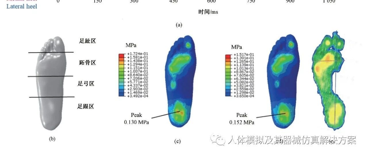 伴有足中关节炎的扁平足患者矫正鞋垫的生物力学研究