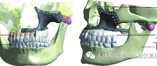 上颌骨复杂缺损3D打印精准重建支架的生物力学研究