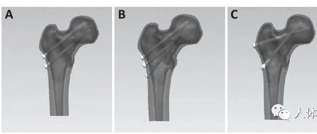 三种空心钉构型固定Pauwels Ⅲ型股骨颈骨折的有限元分析