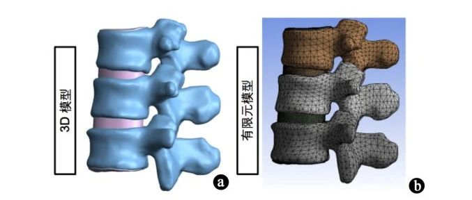 骨质疏松性椎体压缩骨折不同骨水泥分布的临床观察及生物力学的有限元分析