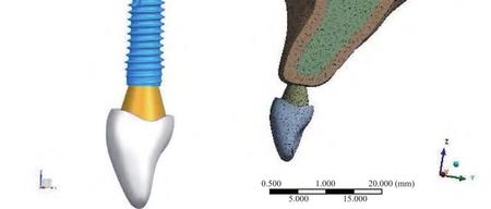 植入位点及轴向对上颌中切牙即刻种植即刻负重后微动度影响的三维有限元分析