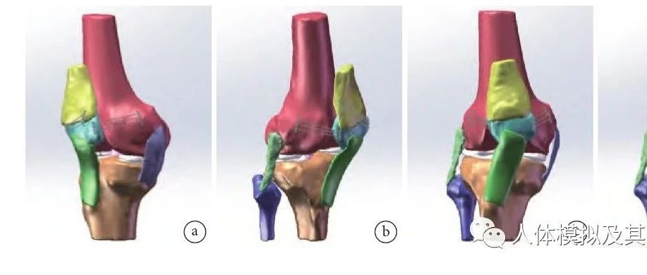 伸膝装置联合重排治疗复发性髌骨脱位的三维有限元分析