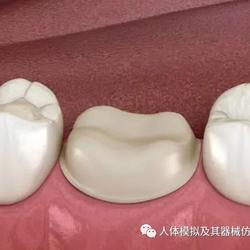 下颌第一磨牙不同桩核位置数目金合金桩核修复后基牙应力的三维有限元分析