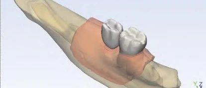 短种植体应用于垂直骨量不足下颌磨牙种植修复的 三维有限元研究