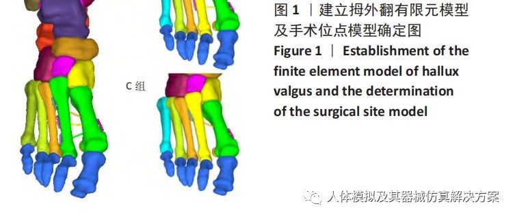 跖骨间弹性固定矫正拇外翻畸形后应力变化的有限元分析