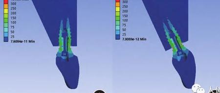 前牙美学区种植 ASC 螺丝固位修复的三维有限元分析