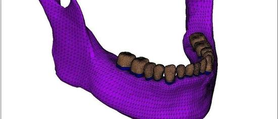口腔冠修复模型构建及有限元分析应用