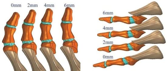 微创治疗拇外翻截骨端位移与跖痛症量化关系的有限元分析