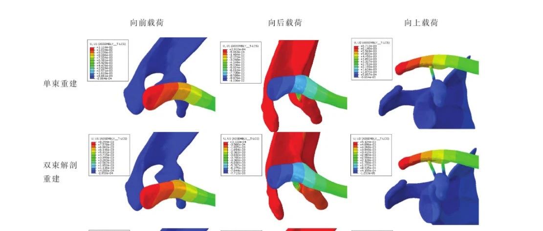 喙锁韧带不同重建方法治疗肩锁关节脱位的有限元分析