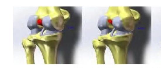 前交叉韧带部分断裂对膝关节应力影响的三维有限元分析