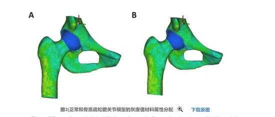 正常与骨质疏松髋关节模型的建立及有限元分析