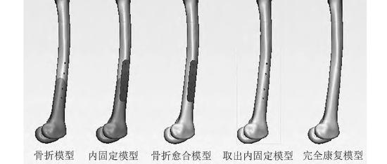 股骨干骨折钢板内固定术后骨折部位生物力学改变的有限元分析