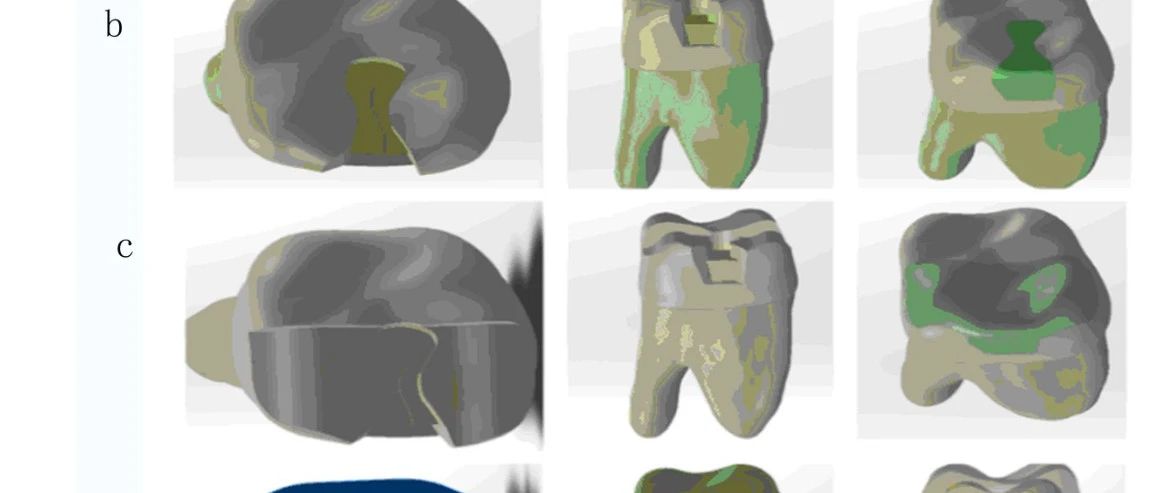 不同修复方式对隐裂牙抗力影响的有限元分析