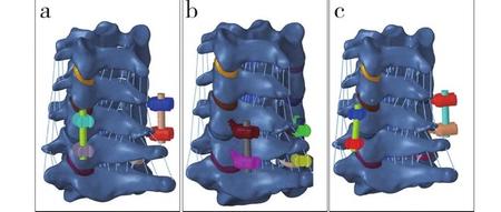 颈椎椎间孔螺钉、侧块螺钉、椎弓根螺钉生物力学强度有限元分析