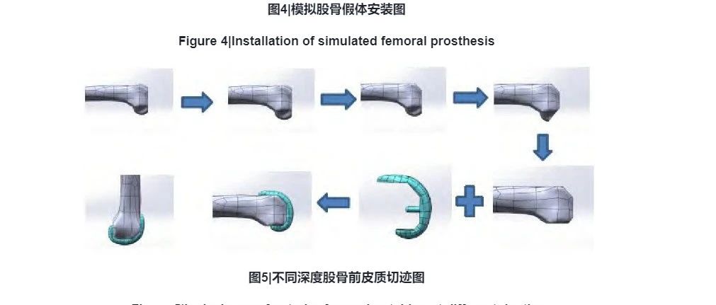 不同骨强度下全膝置换过程中发生股骨前皮质切迹的三维有限元分析