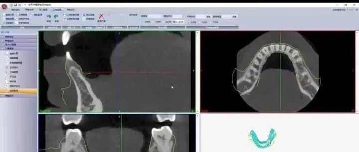 中国首套复杂义齿人工智能三维设计软件：维视全口义齿设计软件(3D医学数字牙科CAD/CAM)