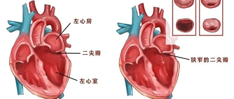 人体心脏瓣膜建模技术与流固耦合模拟仿真：细节与要点剖析