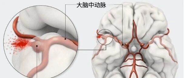 血流动力学仿真赋能器械创新！助力临床精准掌控颅内动脉瘤治疗