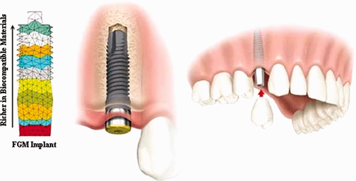 Application of functionally graded material in implants