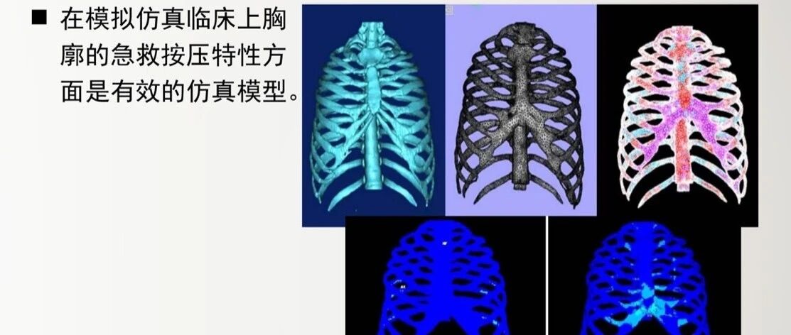 ANSYS在生物力学医疗方面的应用案例